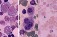 Miyelodisplastik Sendrom Belirtileri ve Tedavisi