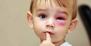 Çocuklarda Nefrotik Sendrom Belirtileri ve Tedavisi