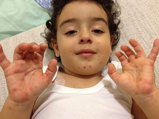 El Ayak Sendromu Belirtileri ve Tedavisi