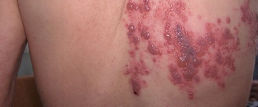 Dress Sendromu Belirtileri ve Tedavisi