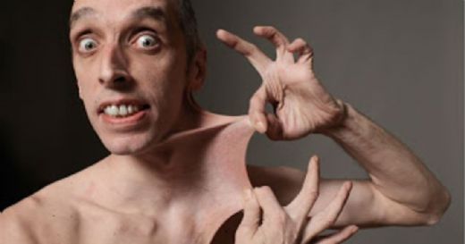 Ehler Danlos Sendromu Belirtileri ve Tedavisi