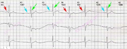 Hasta Sinüs Sendromu Nedenleri
