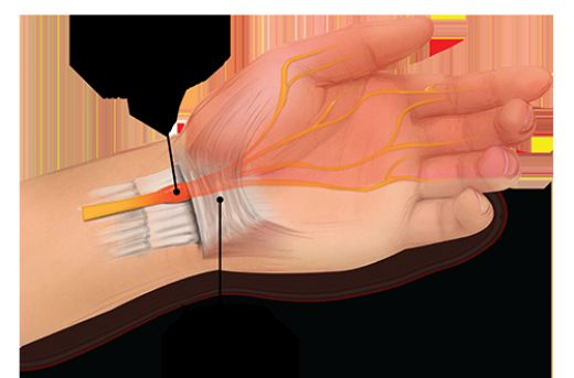 Karpal Tnel Sendromu Ameliyat