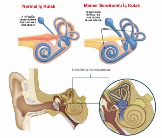 Meniere Sendromu