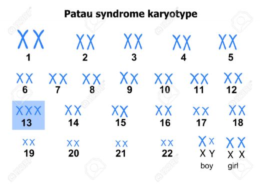 Patau Sendromu