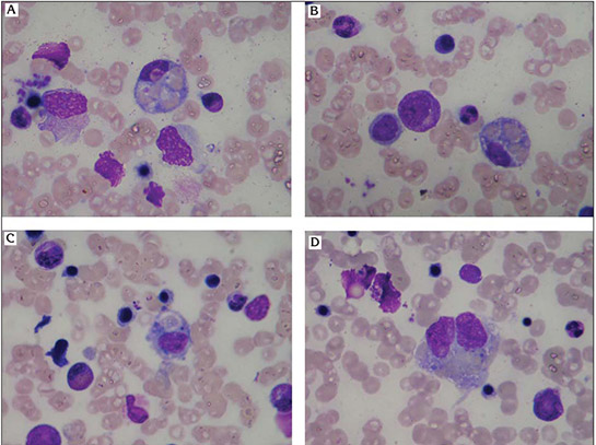 Hemofagositik Sendrom