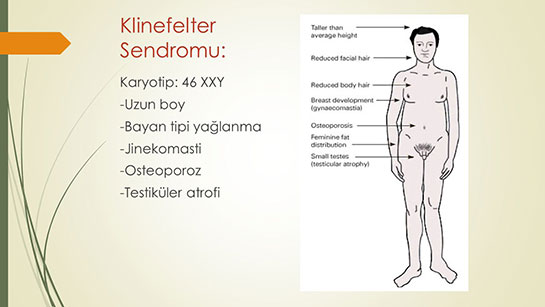 Klinefelter Sendromu