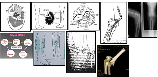 Kompartman Sendromu