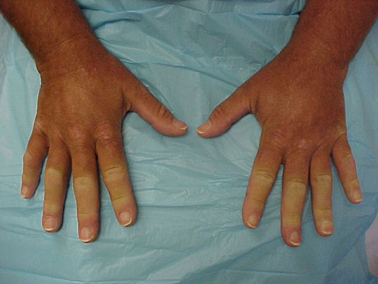 Raynaud Sendromu